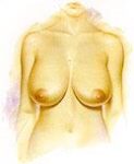 breast-reduction_fig-a